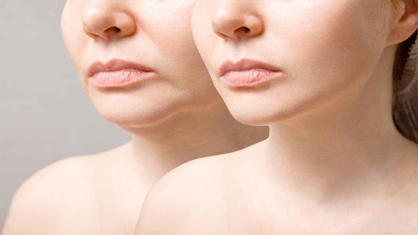 What Is Kybella Double Chin?