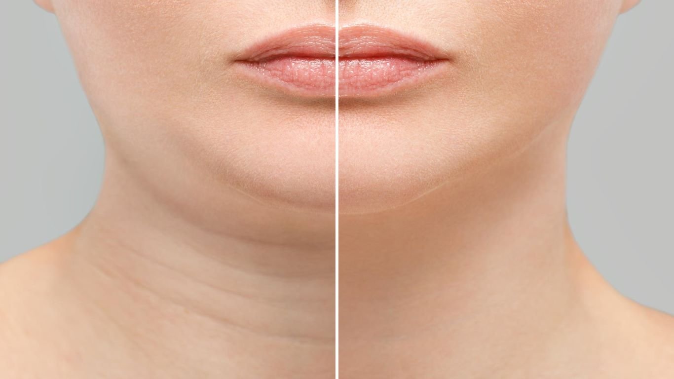 Treatment For Double Chin