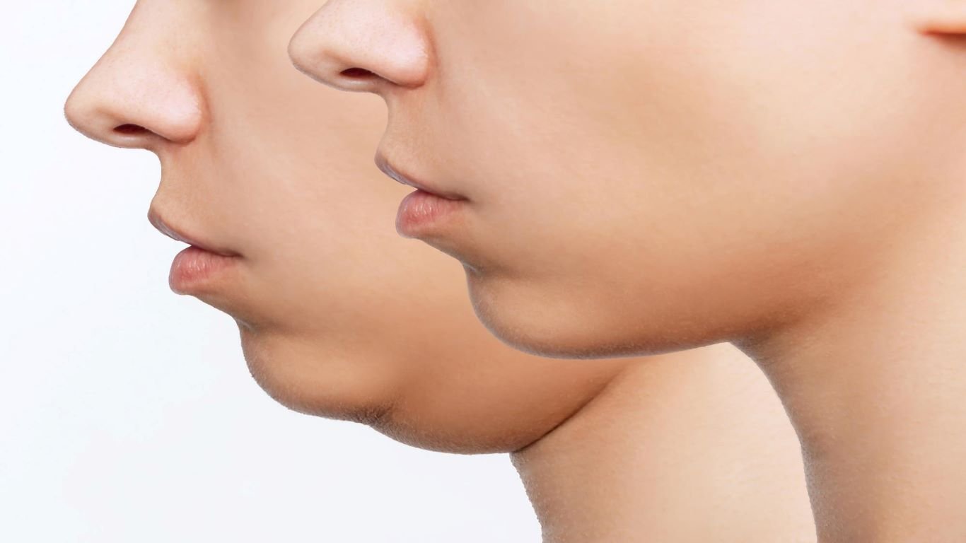 Double Chin Removal Non-Surgical