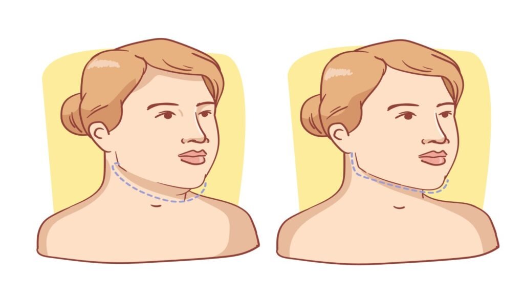 Causes of Double Chin