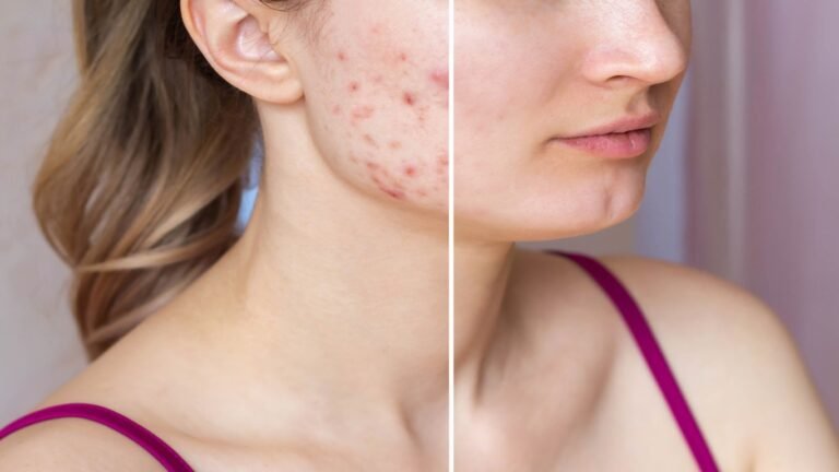 Acne Scarring Treatment