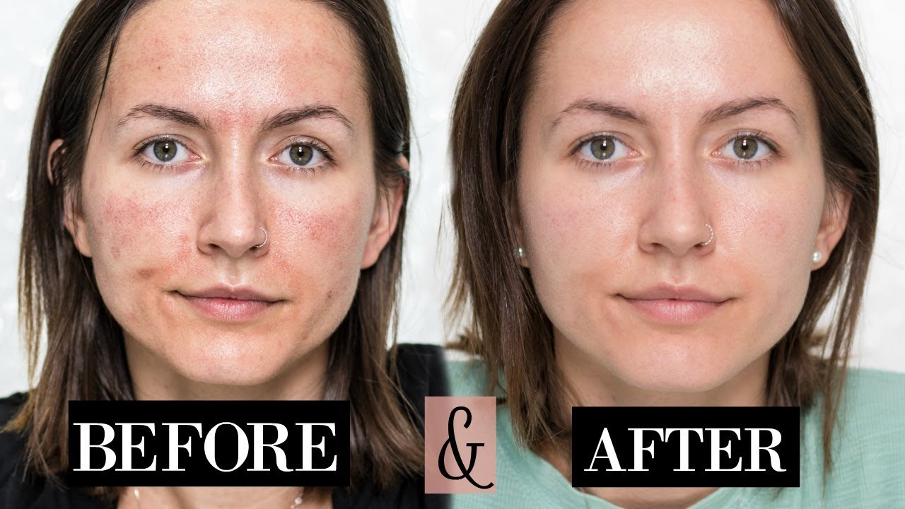 MICRONEEDLING Experience - Before and After