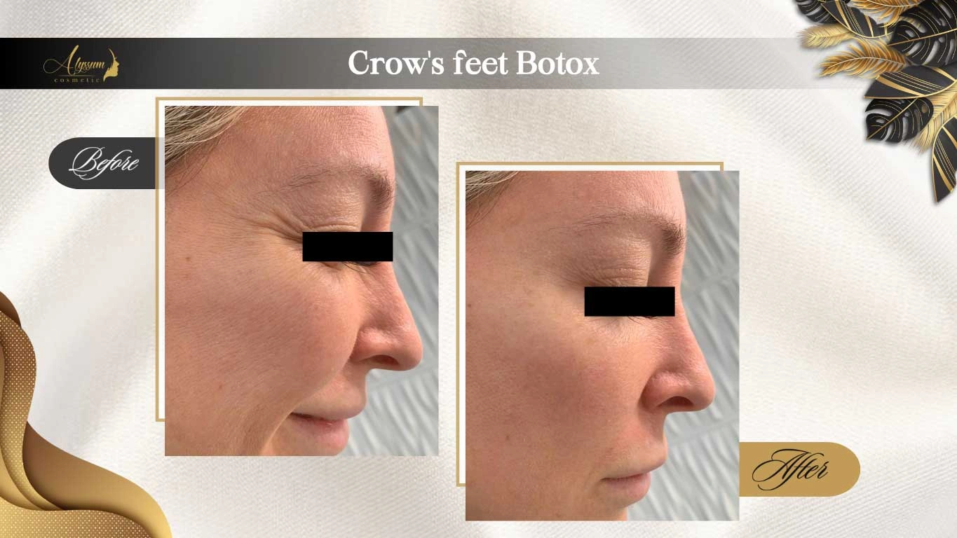 wrinkle treatment- Crow's feet botox