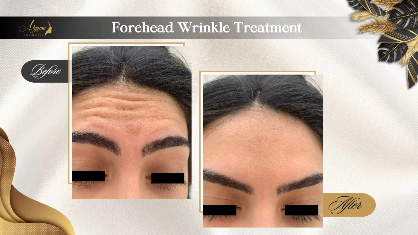 wrinkle treatment- forehead botox