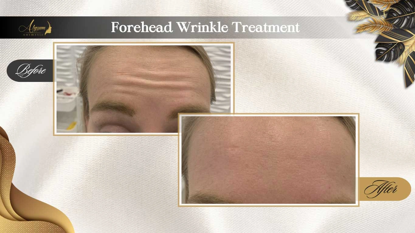 wrinkle treatment- forehead botox