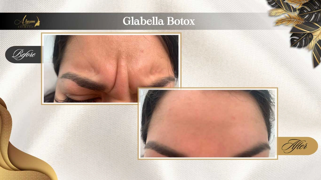 wrinkle treatment- Glabella Botox