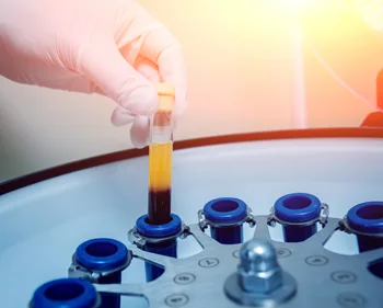 Platelet Rich Plasma Preparation