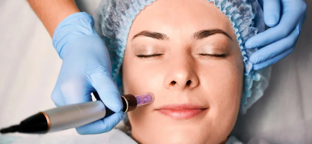 Comprehensive Guide To Microneedling Journey North York