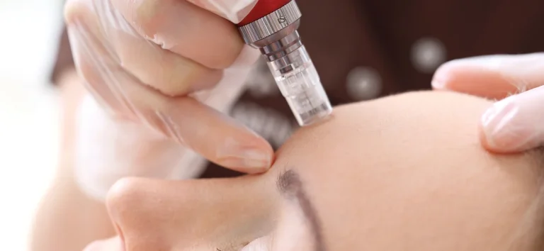 Top Benefits Of Mesotherapy For Anti Aging