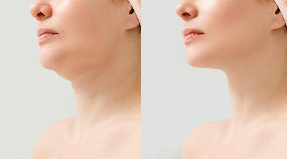 Female Double Chin Before After Correction Correction Chin Shape Liposuction Neck Result Procedure Clinic Aesthetic Medicine