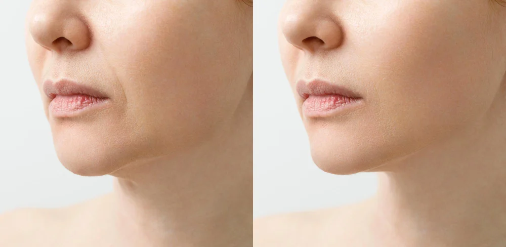 Woman Before After Facial Rejuvenation Procedure Correction Chin Shape Liposuction Neck Result Procedure Clinic Aesthetic Medicine